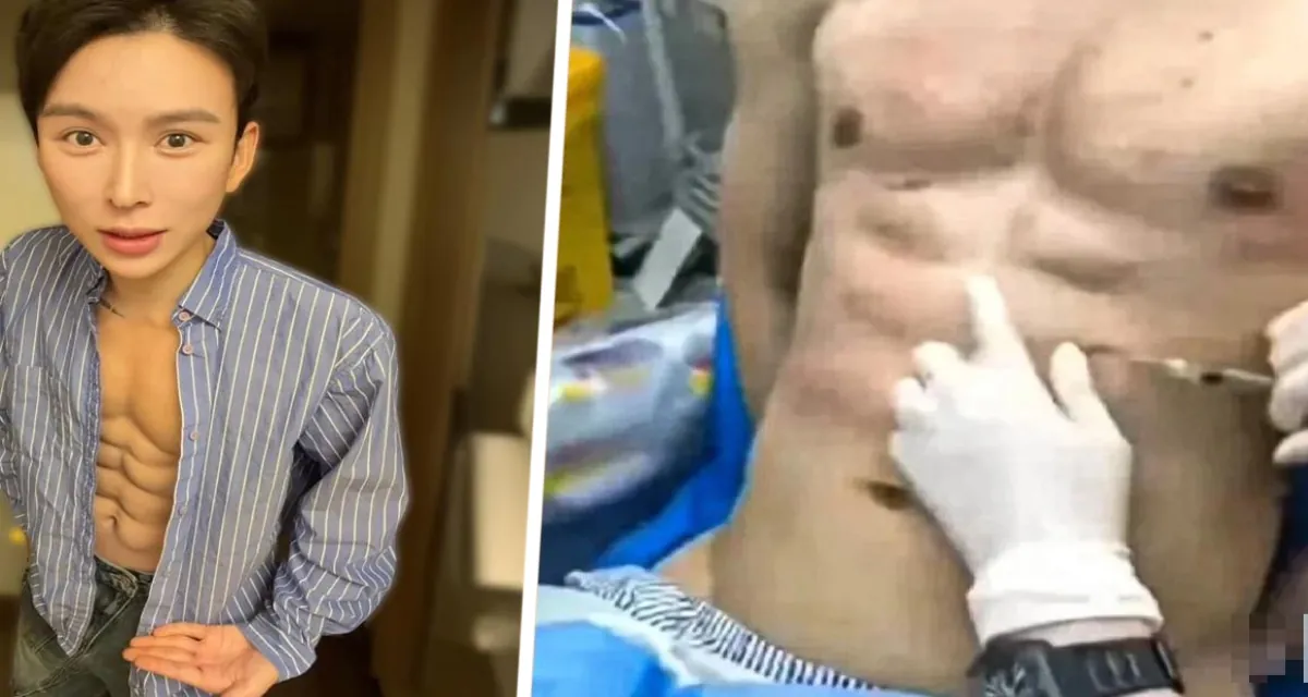 Пресс за полмиллиона: Китайский блогер променял спортзал на шприц и гиалурон