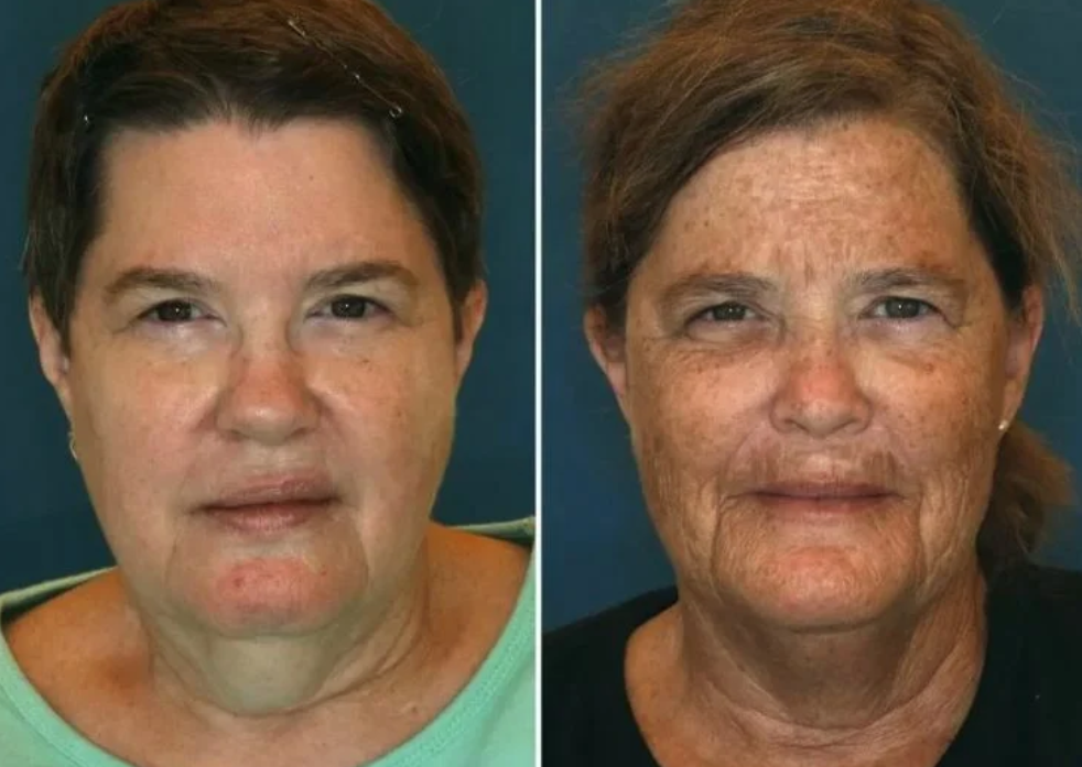 Лица однояйцевых близнецов в 61 год ошеломили врачей различием из-за курения и солнца