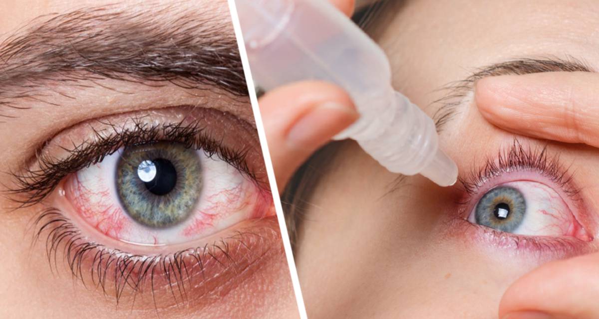 Офтальмолог назвал 6 причин покраснения глаз