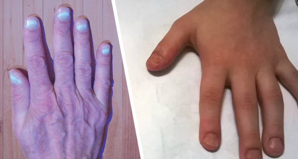 Врачи назвали симптом рака легких на ногтях, указав еще 9 других признаков