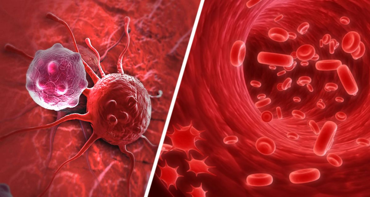 Британские эксперты назвали 6 признаков рака крови