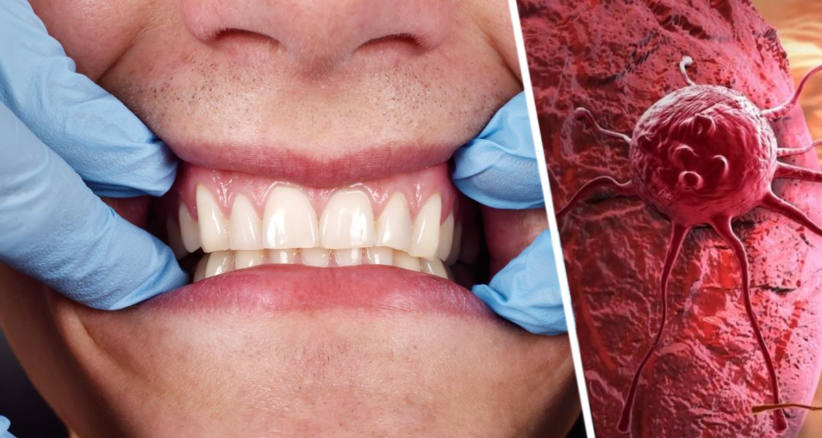 Стоматолог назвал смертельные признаки рака полости рта