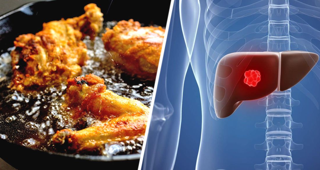 Ученые установили, что жирная пища может привести к раку печени